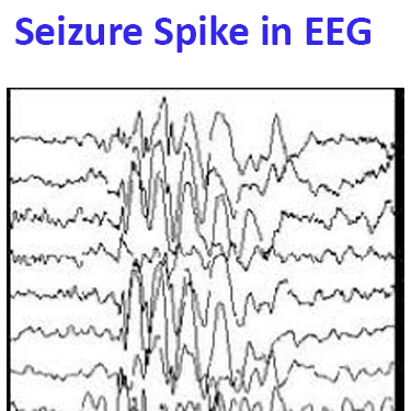 Image of EEG qEEG showing alpha seizure spike