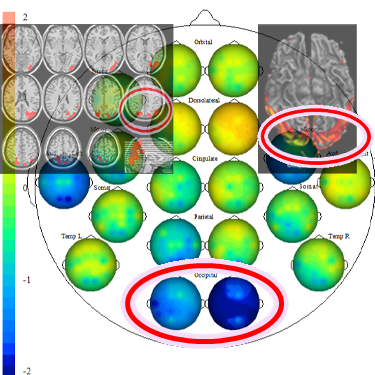 Occipital hypoperfusion in Alzheimer's patients shows in brain map / Kaiser Neuromap