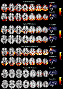 Dementia with Lewy Bodies, Alzheimer Disease and Parkinson's Disease fMRI patterns per Caminiti et al, 2019