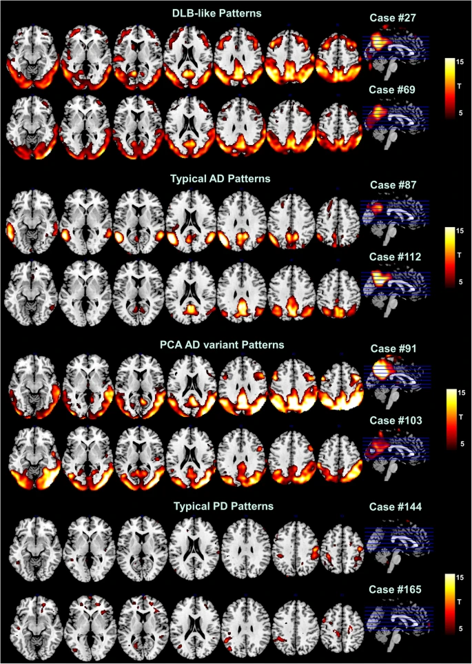 Dementia with Lewy Bodies, Alzheimer Disease and Parkinson's Disease fMRI patterns per Caminiti et al, 2019
