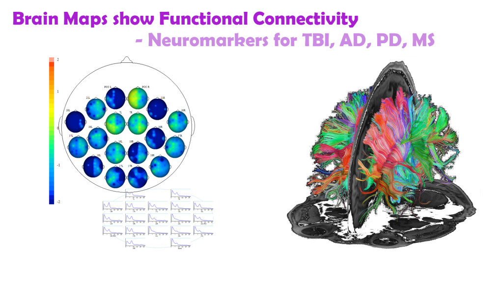 Neurodegeneration in the form of Alzheimer's, Parkinson's, Huntington's Disease, Multiple Sclerosis or TBI can be detected with a qEEG brain map revealing altered functional connectivity neuromarkers