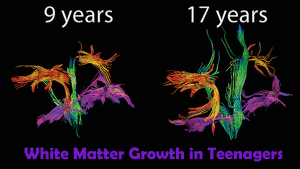 White Matter Tract growth in children and teenagers shown using DTI, this can be improved with neurofeedback training