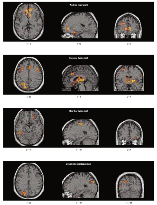 fMRI showing neural correlates of OCD behaviour patterns of washing, checking, hoarding and aversive control; Mataix-Cols et al, 2004