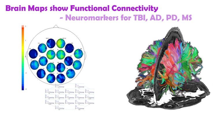 Brain maps reveal neuromarkers for neurodegenerative disease such as Alzheimer's, Parkinson's, Multiple Sclerosis, mTBI