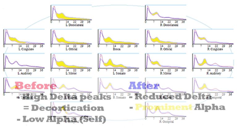 Alpha peaks forming following neurofeedback training implies increased cortication and maturity.
