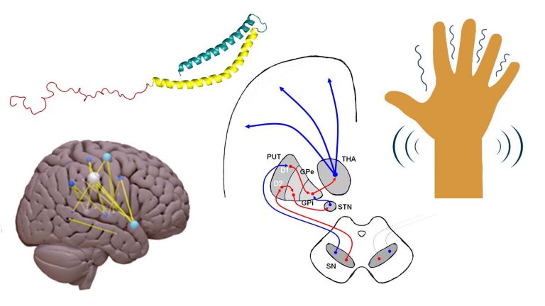 Parkinson's Disease caused by alpha synuclein in substantia nigra and affecting functional connectivity in the brain, inducing tremors, which can be detected and ameliorated with neurofeedback
