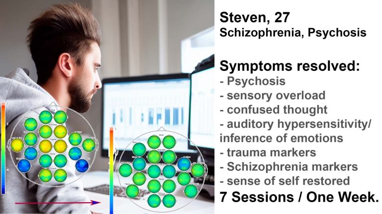 Steven's psychosis and schizophrenia markers disappeared after a one week intensive neurofeedback course, including his trauma markers and auditory hypersensitivity