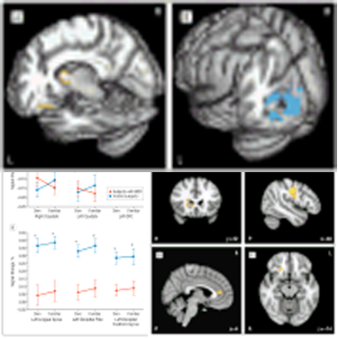 fMRI signature of Body Dysmorphia Disorder
