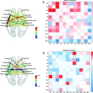 Functional Connectivity in key language areas restored in neurofeedback training for aphasia